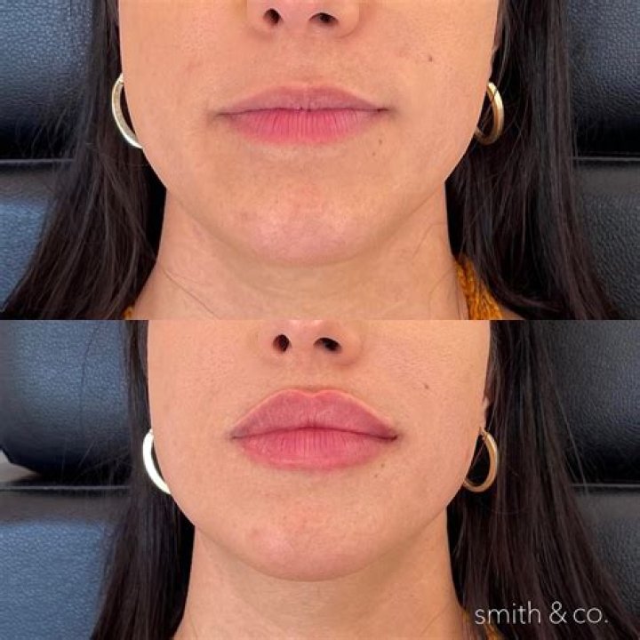 Beth Dutton Lip Injections: Surgery Before And After Photos